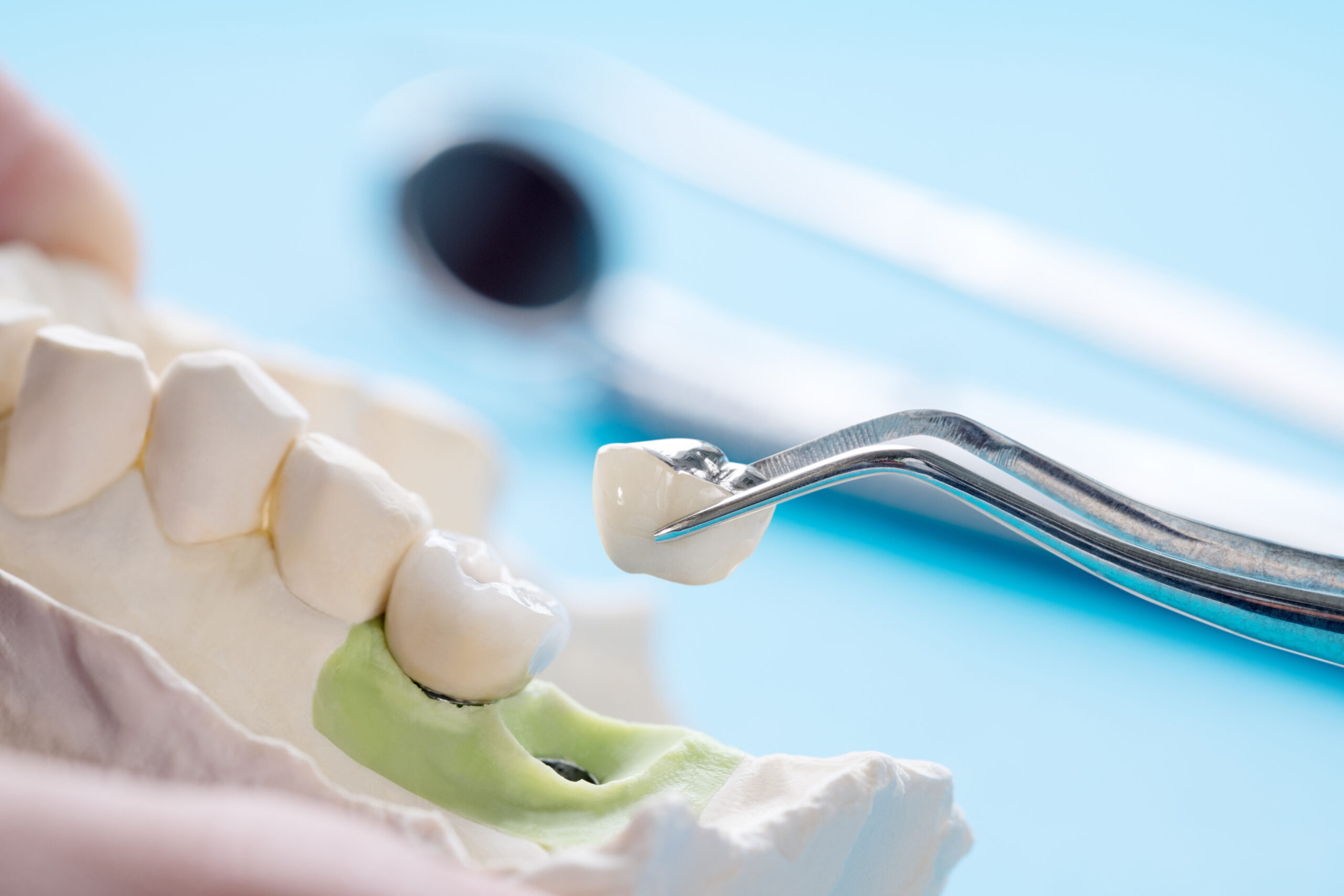 Close up Implan model tooth support fix bridge implan and crown.