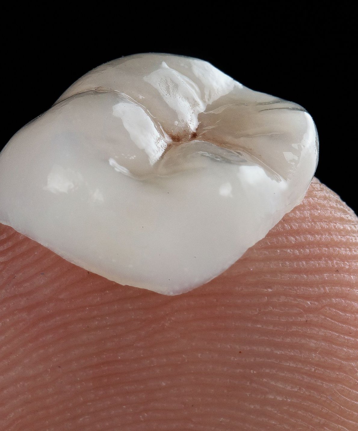 Single porcelain veneer resting on a fingertip